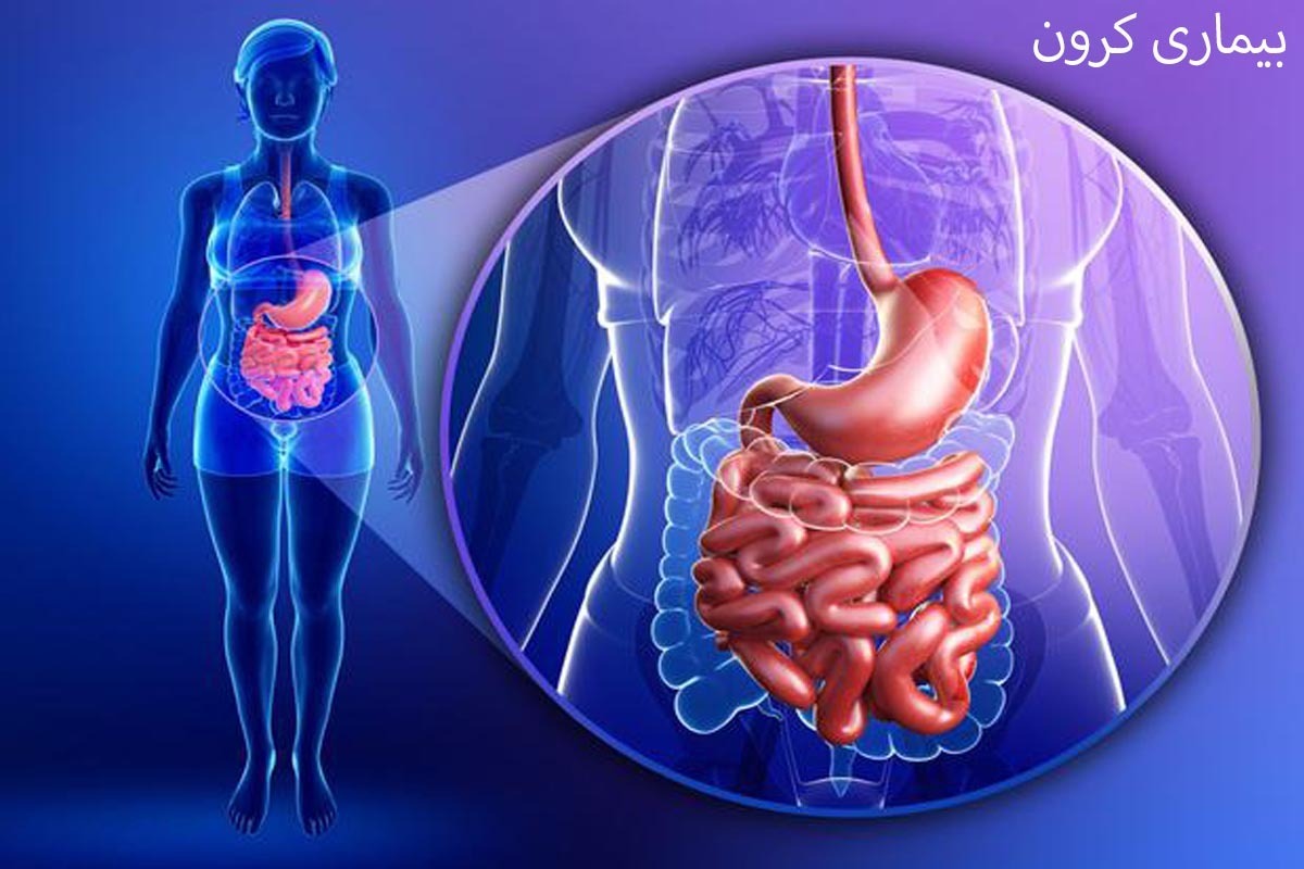 «کرون»؛ یک بیماری گوارشی و غذاهایی که به کاهش علایم آن کمک می‌کند