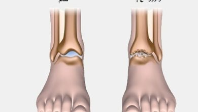 علت درد مچ پا هنگام راه رفتن