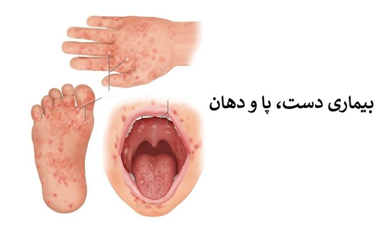 دانستنی هایی درباره بیماری «دست، پا و دهان»/ نامی چند بخشی برای یک بیماری