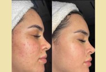 از بین بردن جای جوش در یک روز