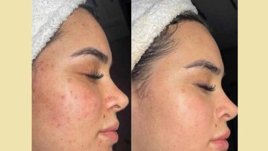 از بین بردن جای جوش در یک روز