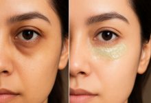 از بین بردن سیاهی زیر چشم