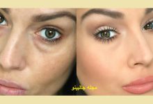 از بین بردن پف زیر چشم فوری