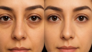 مراقبت های بعد از بلفاروپلاستی