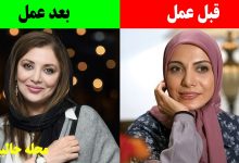 رویا میرعلمی قبل و بعد عمل