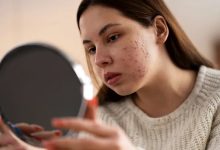 سریعترین روش از بین بردن جای جوش