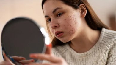 سریعترین روش از بین بردن جای جوش